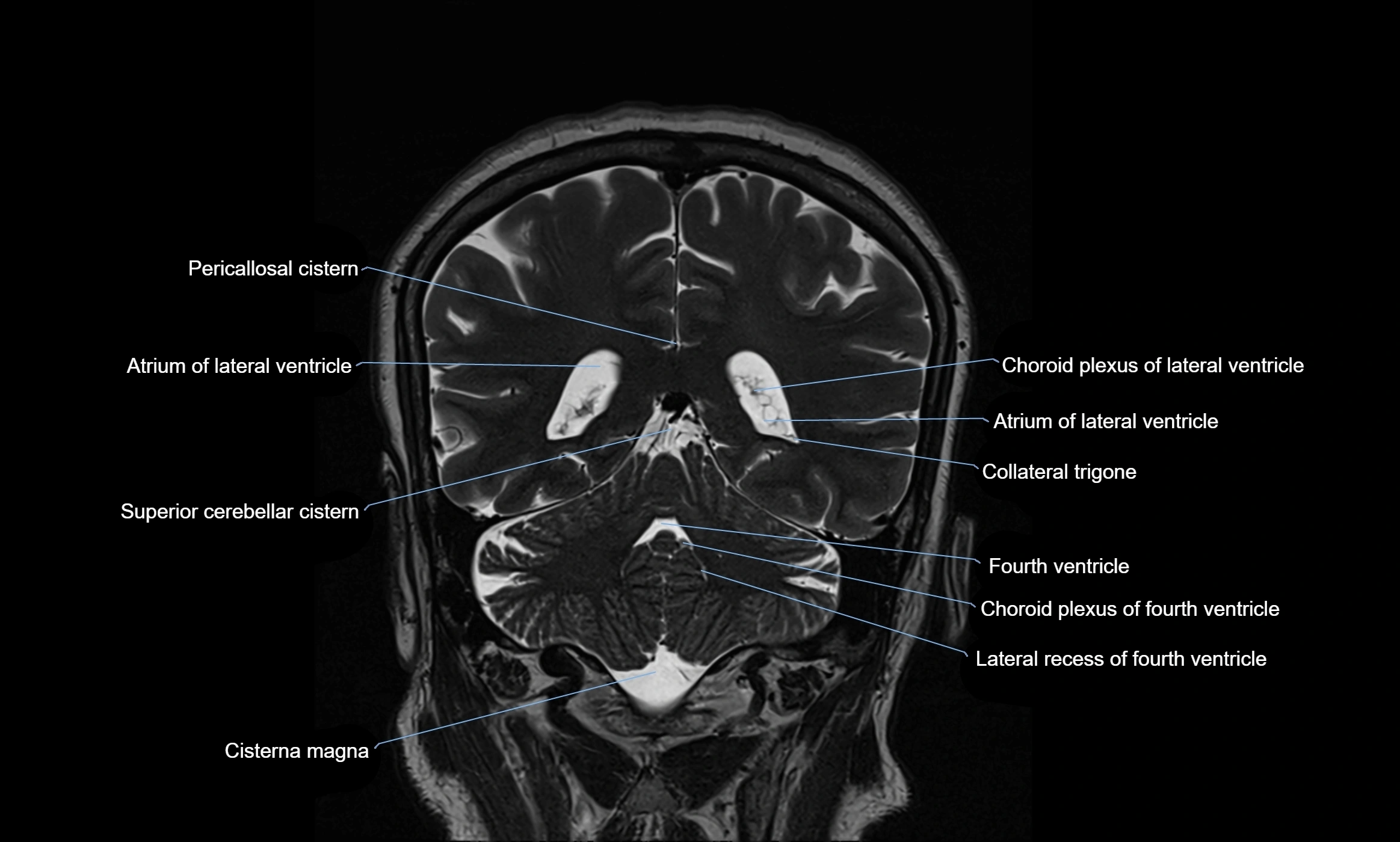 Brain cisterns  and ventricles coronal anatomy 3T MRI image-img-00001-00042.webp